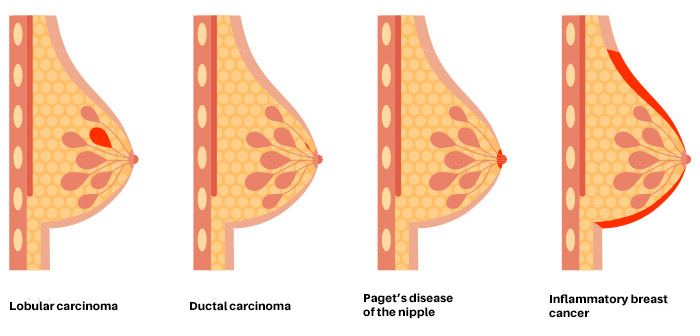 Breast Cancer Classification
